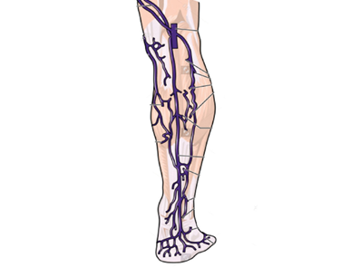 Riskfaktorer för ytlig ventrombos